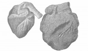 Рис. 6. Нормальное сердце (налево) и перерожденное ожиревшее сердце у пьяницы (направо).